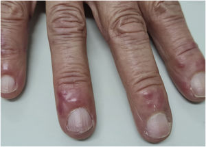 Acrocianose discreta e pápulas eritemato‐infiltradas na região distal dos quirodáctilos.