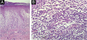 (A) Alongamento dos cones epidérmicos e infiltrado inflamatório linfocitário na interface dermoepidérmica e derme papilar/reticular alta. Há degeneração vacuolar da camada basal e queratinócitos apoptóticos, além de hemácias extravasadas (Hematoxilina & eosina, 100×). (B) Na derme, vaso de pequeno calibre com endotélio tumefeito, demonstrando a agressão vascular. Ao redor, infiltrado inflamatório linfo‐histiocitário e extravasamento de hemácias (Hematoxilina & eosina, 400×).
