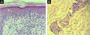 Pele, achados histopatológicos. (A) Dermatite de interface (Hematoxilina & eosina, 400×). (B) Hiperplasia endotelial e plasmócitos em abundância ao redor dos vasos dérmicos (Hematoxilina & eosina, 400×).
