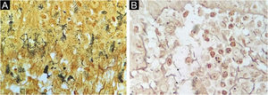 (A) Marcação de fundo da camada basal (Warthin‐Starry, 1000×). (B) Estruturas inespecíficas na derme (setas, Warthin‐Starry, 1.000×).