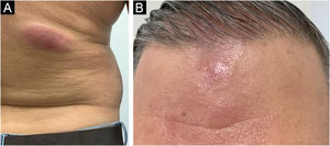 (A) Placa violácea na região dorsal inferior. (B) Nódulo e placas infiltradas e eritematosas na região frontal.