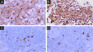 (A) CD45 positivo (400×). (B) CD123 positivo (400×). (C) CD20 negativo na neoplasia e positivo nos raros linfócitos B de permeio (400×). (D) CD3 negativo na neoplasia e positivo nos raros linfócitos T de permeio (400×).