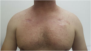Paciente de 36 anos em uso de cetuximabe e reação acneiforme grau 1 na graduação do CTCAE v5.0. Pápulas e pústulas no tronco superior cobrindo menos de 10% da superfície corporal.