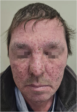 Paciente de 49 anos em uso de cetuximabe com reação acneiforme grau 3 na classificação do CTCAE v5.0. Pápulas e pústulas cobrindo> 30% da superfície corporal, associado a prurido e dor moderados, além de superinfecção local.