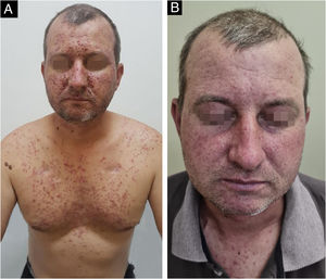 (A) Paciente de 40 anos com erupção acneiforme grau 3 decorrente do uso de panitumumabe para neoplasia colorretal. (B) O mesmo paciente após 14 dias de uso de doxiciclina 100 mg em duas tomadas diárias.