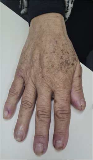 Paciente de 69 anos em uso de cetuximabe e alterações periungueais iniciadas duas semanas após o início da medicação.