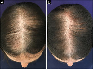 Melhora clínica de paciente com APF em uso de minoxidil 5% solução, 1×ao dia. (A) Antes do tratamento. (B) Após seis meses de tratamento.
