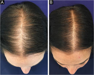 Melhora clínica de paciente com APF em uso de minoxidil oral 1 mg/dia. (A) Antes do tratamento. (B) Após seis meses de tratamento.