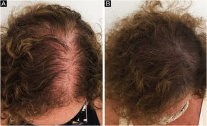 Camuflagem da área com perda capilar com tricomicropigmentação.