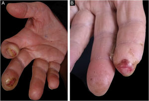 Aspecto clínico. (A) Mão direita – ulceração subungueal no indicador, úlcera com borda calosa na falange distal do dedo médio e atrofia da loja tenar. (B) Mão esquerda – ulceração na falange distal do indicador com diminuição do tamanho da falange e área cicatrizada na falange distal do dedo médio.