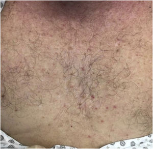 Erupção eritematosa contendo máculas e pápulas.