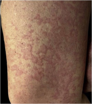 Erupção urticariforme.