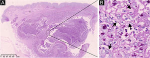 Histopatologia. (A) Abscesso dérmico (coloração pelo ácido periódico‐Schiff, 20×). (B) Hifas intracelulares (pontas de seta) em células multinucleadas do granuloma (coloração pelo ácido periódico‐Schiff, 400×).