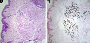 (A) Epiderme sem alterações, derme com fibras elásticas fragmentadas, espessadas e basofílicas (Hematoxilina & eosina, 40×). (B) Coloração de Von Kossa positiva para deposição de cálcio nas fibras elásticas (Von Kossa, 40×).