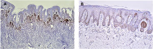 Imuno‐histoquímica com Ki67 em nevo melanocítico congênito. A imunorreatividade com Ki67 foi restrita ao núcleo das células em padrão granular distinto e mais frequentemente foi observada em células localizadas na junção dermoepidérmica (A‐B, 100×).