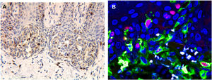 Os núcleos corados em marrom indicam expressão positiva de Ki67 (A, 400×). A microscopia confocal de fluorescência a laser pode facilmente eliminar a interferência dos grânulos de melanina. Células com fluorescência vermelha no centro e fluorescência amarela ao redor são células imunorreativas com Ki67 (B, 600×).