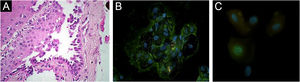 Achados histopatológicos e de imunofluorescência. (A) Acantólise suprabasal em biopsia obtida da mucosa nasal (Hematoxilina & eosina, 63×). (B) Imunorreatividade na superfície de células da mucosa oral com anticorpo IgG anti‐humano conjugado com FITC utilizando imunofluorescência direta (IFD) em esfregaços de Tzanck obtidos da mucosa oral (63×). (C) IFD utilizando esfregaços obtidos por raspagem da conjuntiva ocular com anticorpo anti‐HSV‐1 conjugado com FITC mostrando imunomarcação nuclear (100×).