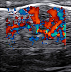 Achados ultrassonográficos (22 Hz). Imagens de Doppler colorido de uma pseudopústula destacando a vascularização intralesional acentuada, juntamente com espessamento dermo‐epidérmico e hipoecogenicidade dermo‐hipodérmica focal.