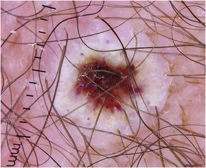 Imagem dermatoscópica. Pseudopústula púbica com centro crostoso avermelhado, circundado por anel esbranquiçado.