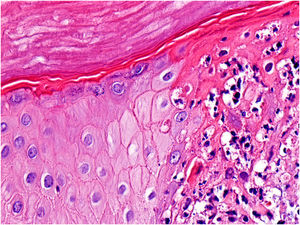 Características histopatológicas (Hematoxilina & eosina, 400×). Queratinócitos epidérmicos com aspecto balonizado e infiltrado inflamatório predominantemente linfocitário nas bordas da lesão.