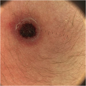 Dermatoscopia com crosta central avermelhada/preta, borda rosada com descamação branca e fina e glóbulos de cor vermelha esparsos entre a crosta e a borda.