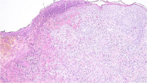 Lesão ulcerada com infiltrado composto por células epitelioides com núcleo em formato de rim, com epidermotropismo (Hematoxilina & eosina, 100×).