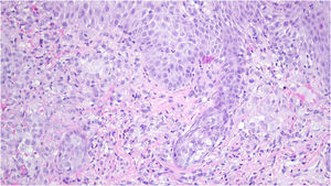 Infiltrado composto por células epitelioides com núcleo em formato de rim, acompanhado de linfócitos, plasmócitos e número significante de eosinófilos (Hematoxilina & eosina, 200×).