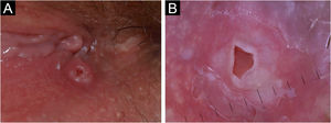 Prega interlabial direita da vulva. (A) Clinicamente, nódulo focalmente ulcerado, único, firme, bem circunscrito, de superfície lisa (4×4mm) não pigmentado. (B) A dermatoscopia mostrou uma ulceração central avermelhada com bordas solapadas devido ao descolamento da superfície mucosa das camadas inferiores, circundada por um halo esbranquiçado, na ausência de outros parâmetros dermatoscopicamente relevantes.