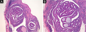 (A) O exame histopatológico mostra neoplasia cística dérmica caracterizada por projeções papilares (Hematoxilina & eosina, 50×). (B) As papilas são revestidas por células mioepiteliais (na periferia) e células colunares altas, mostrando aspecto de secreção por decapitação (Hematoxilina & eosina, 100×).