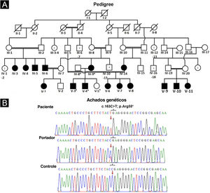 (A) Linhagem de família afetada mostrando segregação de EDSS1 na forma autossômica recessiva. (B) Cromatograma de sequenciamento do gene NECTIN4 indicando variante nonsense (c.163C>T) em homozigose em indivíduos afetados (painel superior), em heterozigose em portador IV‐8 (painel do meio) e alelo do tipo selvagem homozigoto (C) em indivíduo normal (painel inferior). As setas são utilizadas para destacar a posição da variante