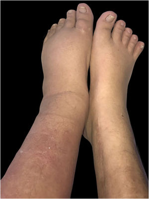 Assimetria dos membros inferiores devido ao aumento da circunferência da perna esquerda associado a eritema em sua região anterior