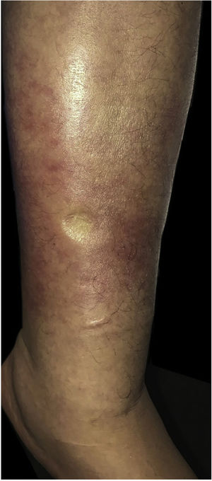 Placa eritematosa e edematosa com bordas difusas na perna esquerda. Edema com sinal de Godet positivo