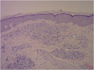 Características histopatológicas (Hematoxilina & eosina, 40×): estruturas arredondadas maiores que as células circundantes contendo múltiplos septos citoplasmáticos, o que lhes confere aparência de mórula. Esporângios em destaque