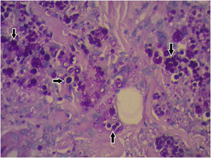 Infiltrado dérmico granulomatoso constituído por linfócitos, histiócitos, células gigantes multinucleadas e estruturas arredondadas, isoladas ou agrupadas, de diversos tamanhos, no interior de histiócitos e células gigantes (Hematoxilina & eosina, 400×)