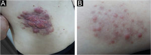 (A) Placa infiltrada eritêmato-acastanhada, com superfície irregular, e múltiplos nódulos vermelho‐escuros de diferentes tamanhos na borda. (B) Lesão do tipo pápulo‐nodular: múltiplas pápulas eritematosas medindo 0,2‐0,5cm agrupadas sobre área de eritema pálido, apresentando‐se isoladas, ou seja, sem fusionamento