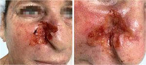 (A) Placa eritematosa infiltrada com exsudação, crostas e ulceração na região malar direita, sobre pele fotodanificada. (B) Exuberante proliferação vascular com extensão para a asa nasal direita