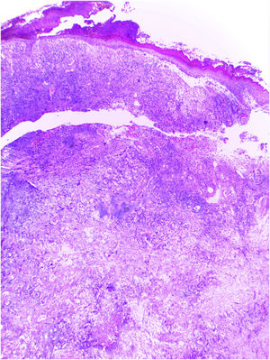 Proliferação maligna epitelioide com ilhas de células claras e áreas de necroses. Algumas células apresentam citoplasma vacuolado (Hematoxilina & eosina, 100×)