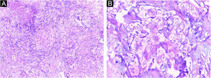 (A) Carcinoma espinocelular com diferenciação de células claras demonstrando células com citoplasma claro a vacuolado (Hematoxilina & eosina, 200×). (B) Células claras em meio a área de diferenciação escamosa, com raros focos de queratinização (Hematoxilina & eosina, 400×)