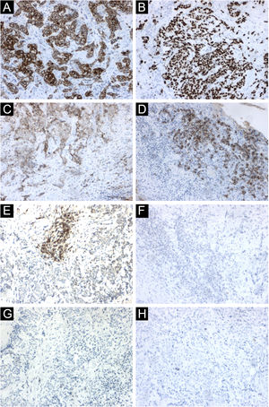 Achados imuno‐histoquímicos. (A) Positividade das células neoplásicas para citoqueratina 5/6. (B) Positividade das células neoplásicas para p63. (C) Positividade focal para BerEp4. (D) Positividade focal para EMA. (E) Positividade focal para fator XIIIa. (F) Negatividade de células neoplásicas para adipofilina. (G) Negatividade de células neoplásicas para receptor de andrógeno. (H) Negatividade de células neoplásicas para CEA