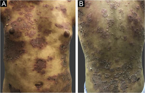 (A e B) Dermatose disseminada caracterizada por placas eritematosas circinadas sobrepostas por pústulas na periferia das lesões