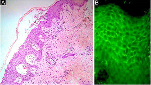 (A) Fragmento de pele mostrando clivagem intraepidérmica com pústula subcórnea (Hematoxilina & eosina, 40×). (B) Imunofluorescência direta positiva intercelular para imunoglobulina do tipo IgA