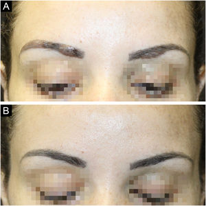 (A) Placas infiltradas e bem delimitadas em topografia de ambas as sobrancelhas; rarefação dos pelos. (B) Regressão completa das lesões com repilação das sobrancelhas