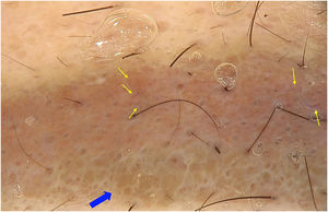 Dermatoscopia (20×) demonstrando área de coloração marrom‐alaranjada homogênea com rarefação dos pelos (seta azul) e vasos lineares (setas amarelas)