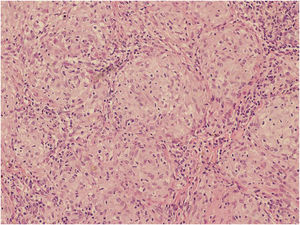 Anatomopatológico demonstrando granulomas não caseificantes de padrão sarcoide (Hematoxilina & eosina, 50×)