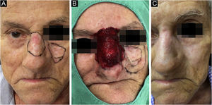 Paciente com demarcação de 02 lesões contiguas de carcinoma basocelular nodular (A), ato operatório, com margens cirúrgicas delimitadas, e uma das lesões em pós‐tratamento com microinfusão de medicamento na pele (B), e resultado após 6 meses de tratamento (C)