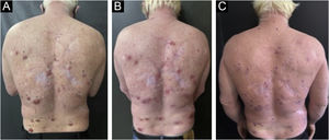 Paciente albino com múltiplas lesões de CBC, demonstrando lesões pré‐tratamento (A), seguidas de lesões em processo cicatricial após 1 mês de tratamento (B) e resultado cicatricial após 6 meses (C)