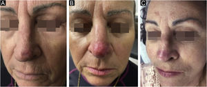 Lesão de carcinoma basocelular nódulo‐esclerodermiforme em ponta nasal, mostrando a lesão pré‐tratamento (A), resultado pós 1 mês (B) e 6 meses de tratamento (C)