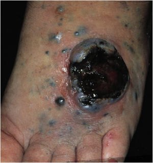Paciente com metástases cutâneas de melanoma com lesão tumoral ulcerada e diversas pápulas e nódulos satélites no pé