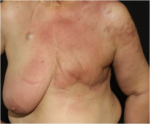 Placa eritematosa e infiltrada no tórax em paciente com metástase cutânea de câncer de mama