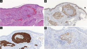 (A) Nódulos de células atípicas dentro de capilares dérmicos em um caso de metástase de adenocarcinoma de mama (Hematoxilina & eosina, 100×). GATA‐3 (B) CK7 (C) e mamoglobina (D) positivos corroboram o diagnóstico